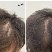 طرح ویژه prp پی آر پی برای ریزش مو و جوانسازی صورت
