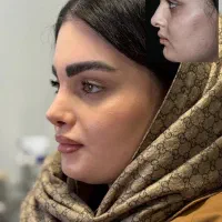 عمل زیبایی بینی با دستگاه پیزو و نصف قیمت