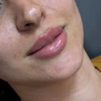انجام خدمات زیبایی فیلر و بوتاکس و مزو
