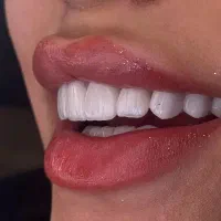 کامپوزیت/ لمینیت/ایمپلنت/بااقساط ویژه