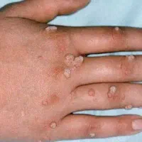 برداشتن خال زیگیل ومیخچه دست پابامحلول گیاهی|خدمات آرایشگری و زیبایی|نیشابور, بنیاد شهید|دیوار