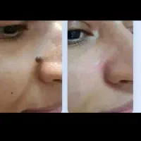 برداشتن خال شروع از دونه ای چهل هزار ....