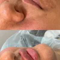 انجام خدمات فیلر و بوتاکس