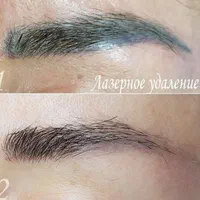 ریمو ابرو به صورت تخصصی و حرفه ایی