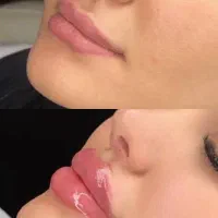 جشنوارتخفیفات ژل و بوتاکس توسط شخص پزشک|خدمات آرایشگری و زیبایی|قم, زنبیل آباد|دیوار