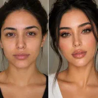 مدل تزریق ژل با تخفیف ویژه