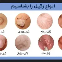 پماد رفع زگیل تناسلی انواع خال و میخچه