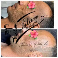 رفع جای جوش تضمینی|خدمات آرایشگری و زیبایی|اصفهان, وحید|دیوار