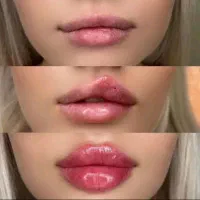 تخفیف تزریق ژل و بوتاکس برای خانم ها و آقایون|خدمات آرایشگری و زیبایی|شاهینشهر, خانه کارگر|دیوار