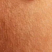 درمان تخصصی خال و زگیل