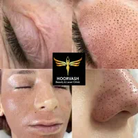 بوتاکس فیلر مزو نخ پی آر پی چربی جوانسازی بدون عمل|خدمات آرایشگری و زیبایی|کرج, گلشهر|دیوار