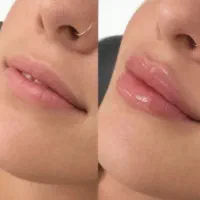 پزشک خانم‌ مسلط به تزریق فیلر