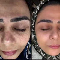 فروش ضد لک ایتالیایی