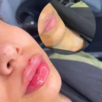 جشنواره ویژه مزوتراپی مو و صورت وفیلروبوتاکس