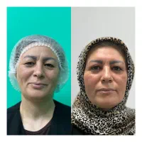 ساکشن غبغب،جراحی بلفاروپلاستی|خدمات آرایشگری و زیبایی|شهرکرد, |دیوار