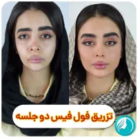 تخفیفات ۵۵٪ دکتر ملائی ،مزو بوتاکس فیلر ژل لب روسی|خدمات آرایشگری و زیبایی|مشهد, سرافرازان|دیوار