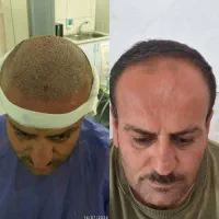 کاشت مو و ابرو|خدمات آرایشگری و زیبایی|تبریز, |دیوار