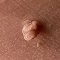 متخصص ویرولوژی / زگیل و تبخال تناسلی