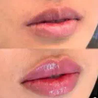 تزریق فیلر ژل وبوتاکس فشیال