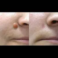 برداشتن انواع خال وزیگل با دستگاه لیزر پیشرفته|خدمات آرایشگری و زیبایی|ارومیه, |دیوار