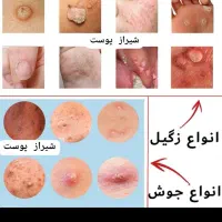 درمان زگیل تناسلی تک جلسه ی لیزر پیشرفته دکترهاشمی