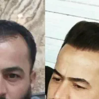جشنواره کاشت مو