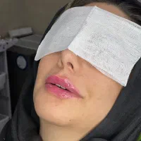 تخفیف خدمات زیبایی ،بوتاکس ،فیلرلب