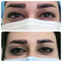 بلفاروپلاستی و تزریق چربی