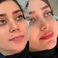 بوتاکس و فیلر لب/ زاویه سازی/جوانسازی/ فیلربادی
