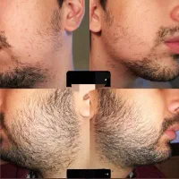 رویش مو ریش سبیل در ۲۰ روز تضمینی