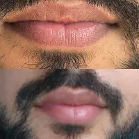 رفع تیرگی دائمی لب (فقط آقایان)|خدمات آرایشگری و زیبایی|اهواز, سپیدار|دیوار