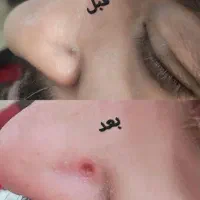 خالبرداری آقایان با مواد گیاهی