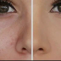 مزونیدلینگ/میکرونیدلینگ