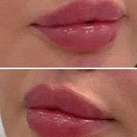 خدمات تخصصی تزریق ژل و بوتاکس|خدمات آرایشگری و زیبایی|فولادشهر, C3|دیوار