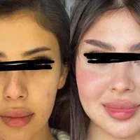 تخفیف فیلر صورت|خدمات آرایشگری و زیبایی|اهواز, زیتون کارمندی|دیوار