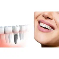 ایمپلنت دندان ۷۹۰۰ با ضمانت ۲۰ ساله|خدمات آرایشگری و زیبایی|کرج, عظیمیه|دیوار