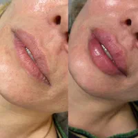 جشنواره لیزر موهای زائد|خدمات آرایشگری و زیبایی|قزوین, |دیوار