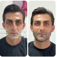 ژل۹۸۰ وفیلر۱۹۰۰و بوتاکس مصبورت ۱۲۸۰مزو ....