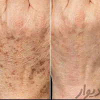 لیزر کک مک خال لیفت لمینت پاکسازی مژه ناخن ژل