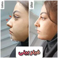 فیلرژل لب،ژل وبوتاکس تخصصی آقاوخانم در مطب پزشک|خدمات آرایشگری و زیبایی|شیراز, قصرالدشت|دیوار