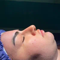 جراحی بینی|خدمات آرایشگری و زیبایی|قائم‌شهر, |دیوار