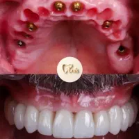 دندانپزشکی فقط باروزی ۱۰۰هزارتومان