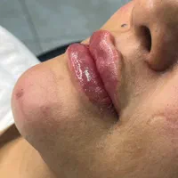 اموزش ژل و بوتاکس و خدمات