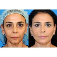 تخفیف ویژه تزریق چربی+ بوتاکس رایگان