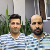 پروتز مو چینی