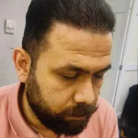 کاشت مو و ابرو فول تراکم تخصصی