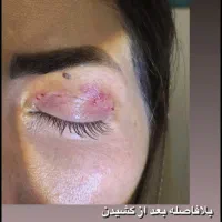 زیبایی لیفت بلفارو فرم بینی بوتاکس نخ ابروزاویه ژل|خدمات آرایشگری و زیبایی|اصفهان, بهارستان|دیوار