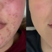 مدل پوست جوش دار و پوست لک دار برای مزونیدلینگ