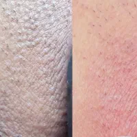 رفع تیرگی بیکینی صورتی سازی تضمینی/زیر نظر پزشک