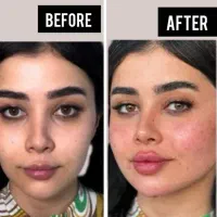 تزریقات توسط پزشک وشرایط اقساط (فیلر بوتاکس ژل)